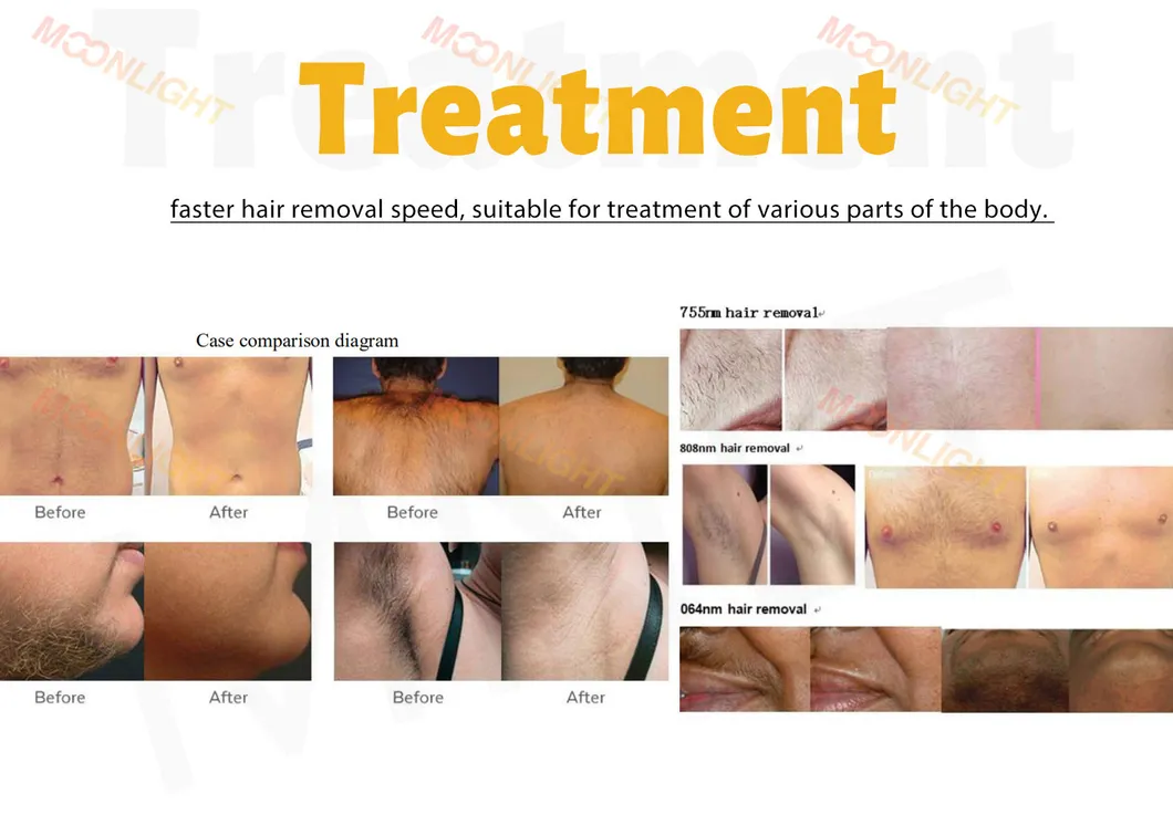 Portable Diode Laser Hair Removal Device for Beauty Salon