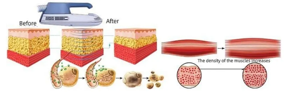 Professional Body Contouring Device for Muscle Building and Fat Loss