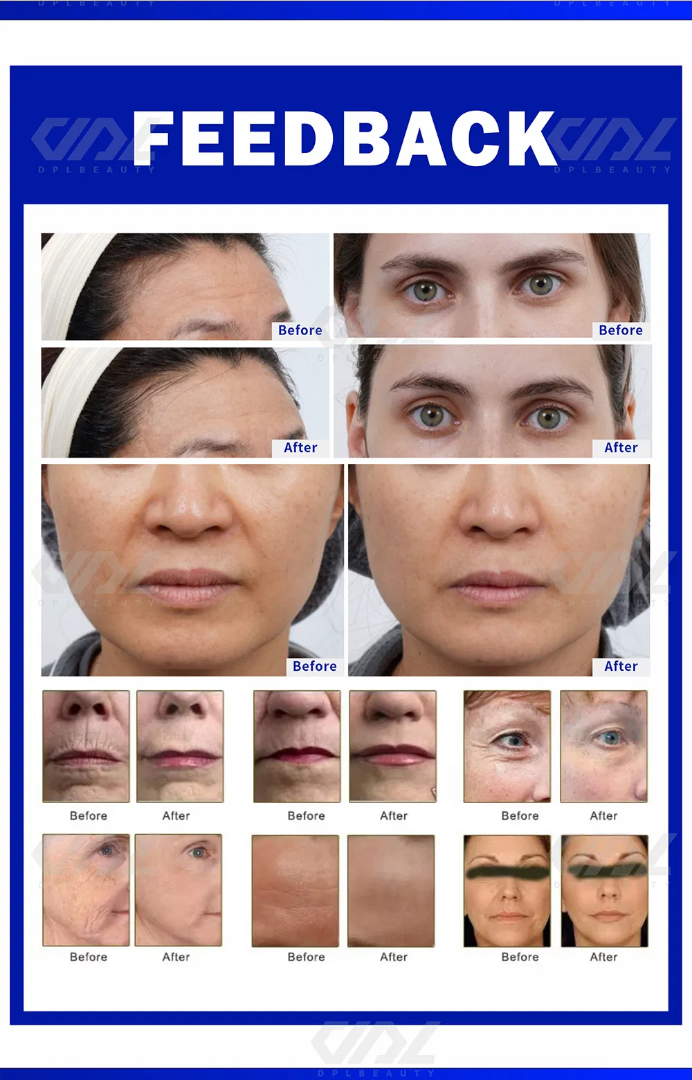 HiFi 2.0 Skin Rejuvenation Wrinkle Removal Face Lift 2400 Shoots Cartridge Anti-Aging Hefu Beauty Device