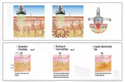 RF Facial Treatment Machine Theory