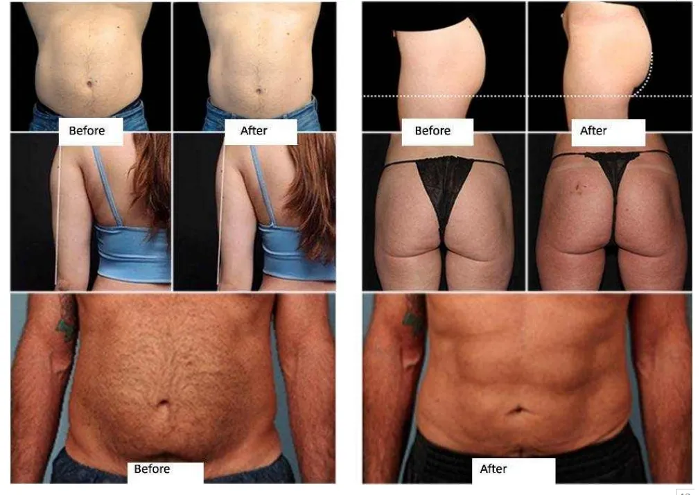 Professional Body Contouring Device for Muscle Building and Fat Loss