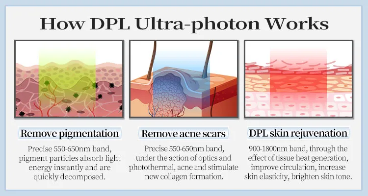 Black Gold Dpl Ultra-Photon Skin Rejuvenation Device Layout 6