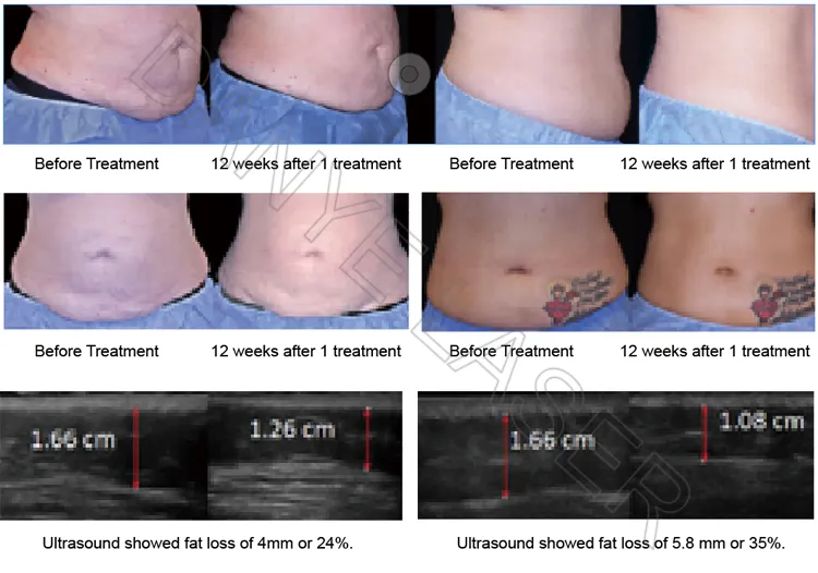 Trusculpt 3D Body Contouring Cutera Trushape ID Cellulite Removal Fat Reduction Device