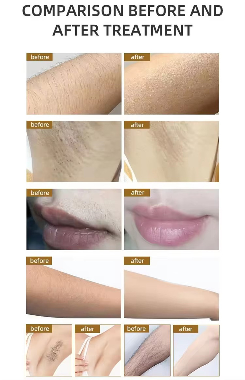 Three-band Hair Removal Device Whole Body Available Safe and Noninvasive Skin Rejuvenation and Firming Improves Skin Texture
