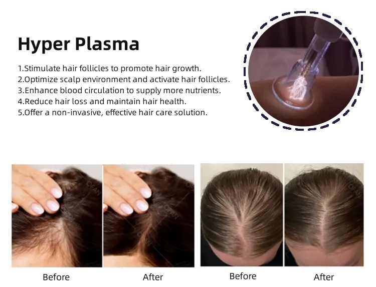 Portable Acne Scars Removal Cold Plasma Treatment Facial Lifting Cold Jet Plasma Cold Plasma Beauty Device