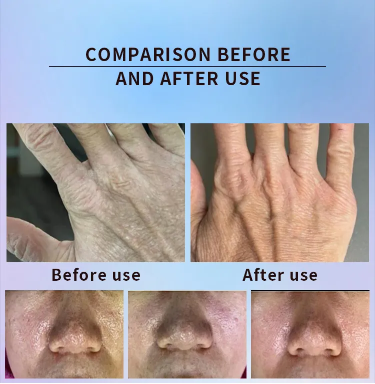 Advanced Cold Plasma Skin Treatment Device for Wrinkles and Acne Scars