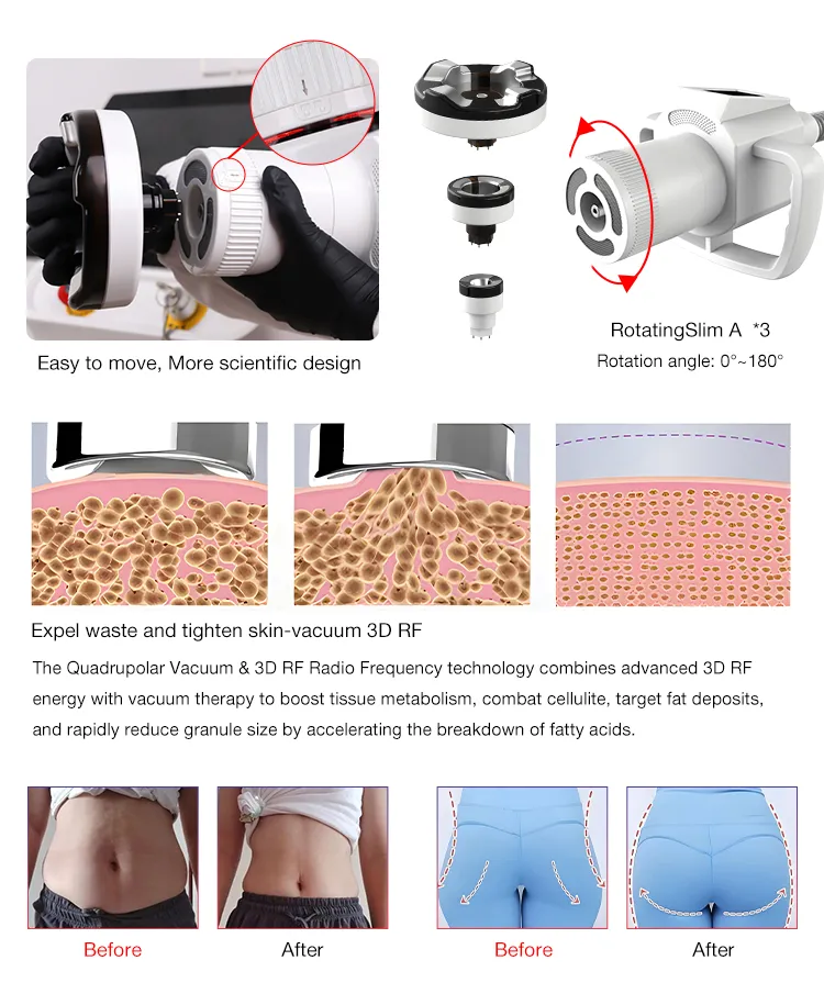 Advanced RF Skin Tightening Device Core Mechanics