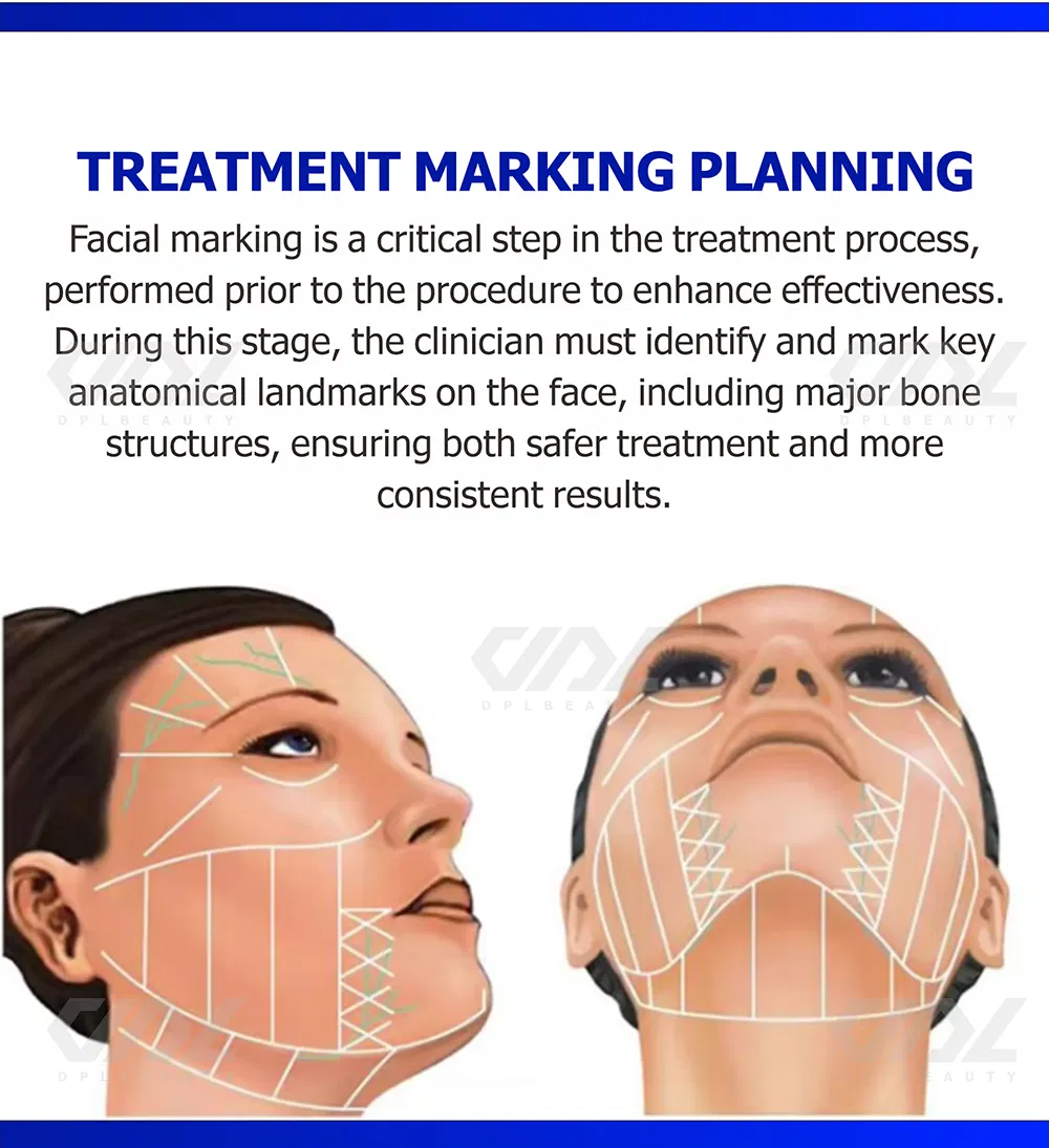 HiFi 2.0 Skin Rejuvenation Wrinkle Removal Face Lift 2400 Shoots Cartridge Anti-Aging Hefu Beauty Device