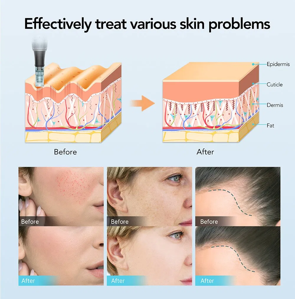 Professional Microneedling Device for Skin Renewal and Rejuvenation