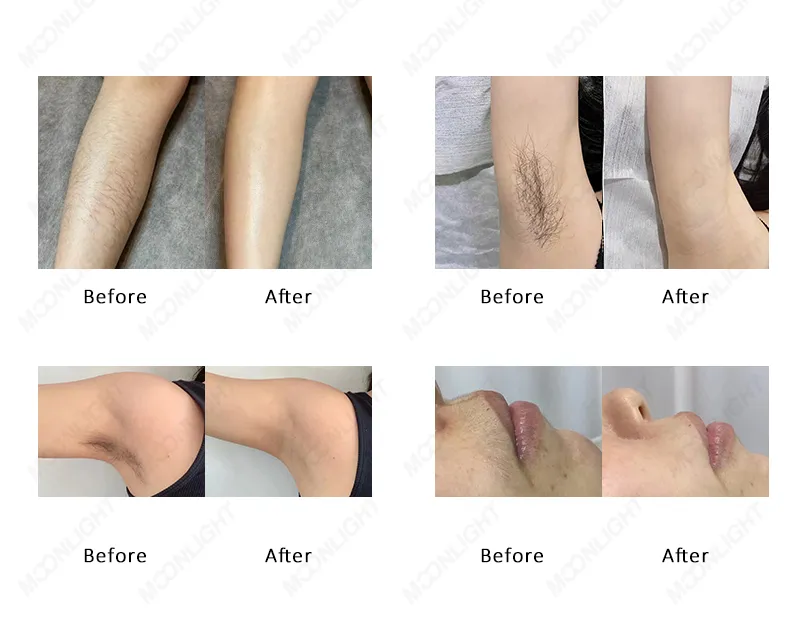Portable Diode Laser Hair Removal Device for Beauty Salon