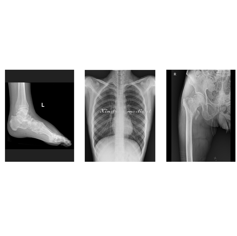 Hospital Flat Panel Detector Based UC-Arm Digital X-ray Radiography System for Sale