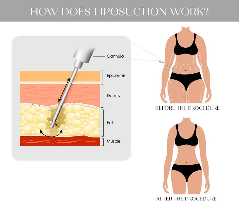 PAL Liposuction System 6