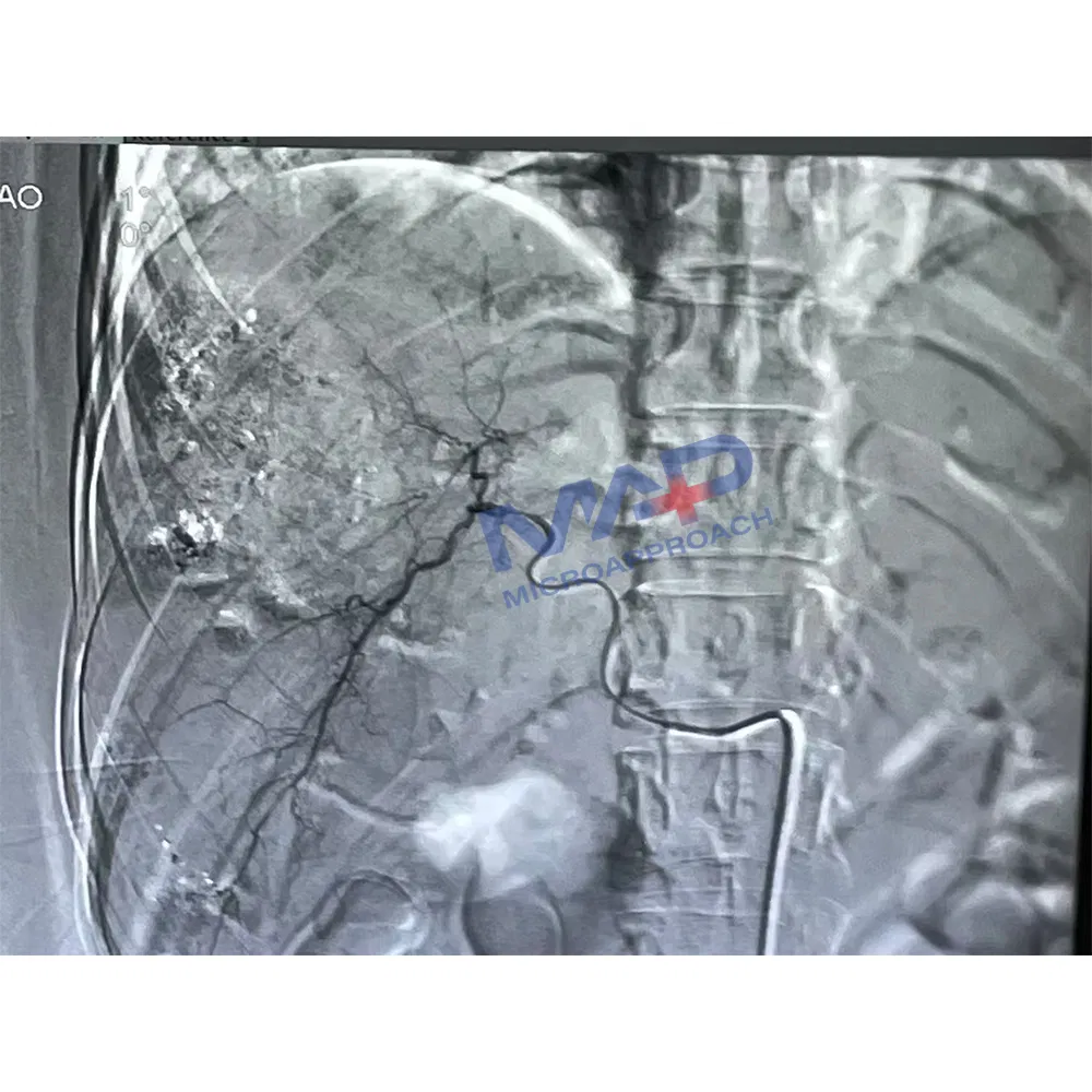Medical Disposable Devices 2.7/2.8f Microcatheter for Peripheral and Coronary