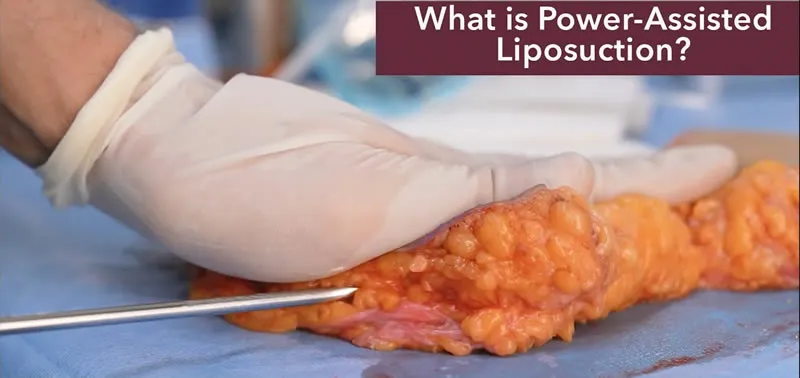 Liposuction Components