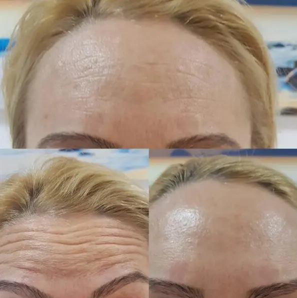 Treatment Result 1