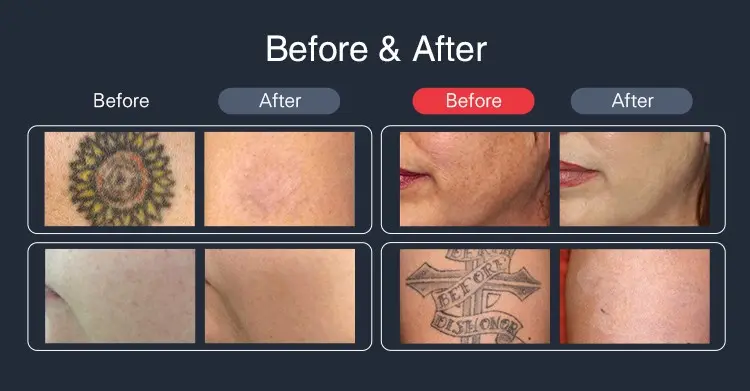 Before and After Treatment Result 1