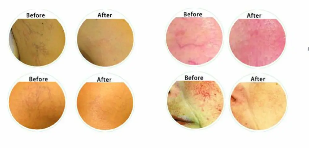 Treatment Effect Before and After