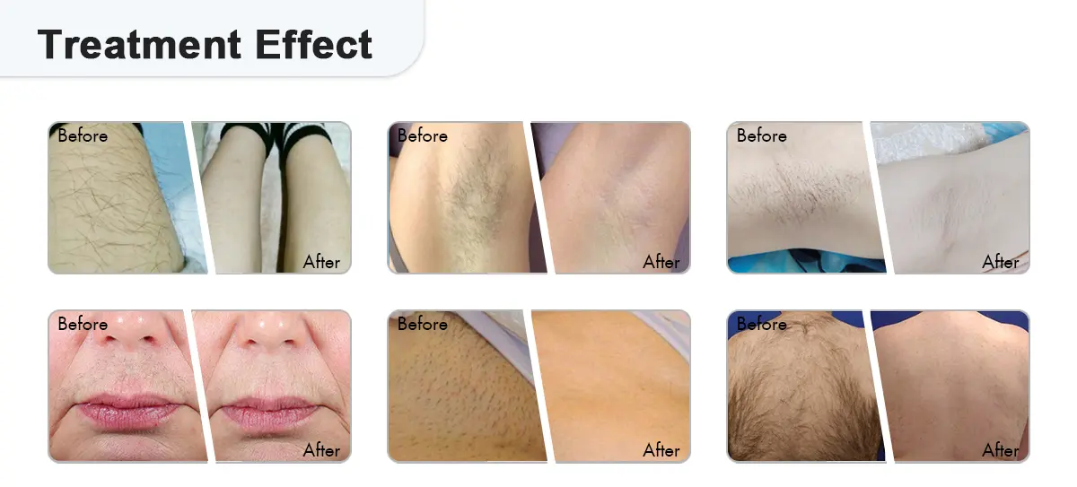 Before and After Treatment Effect