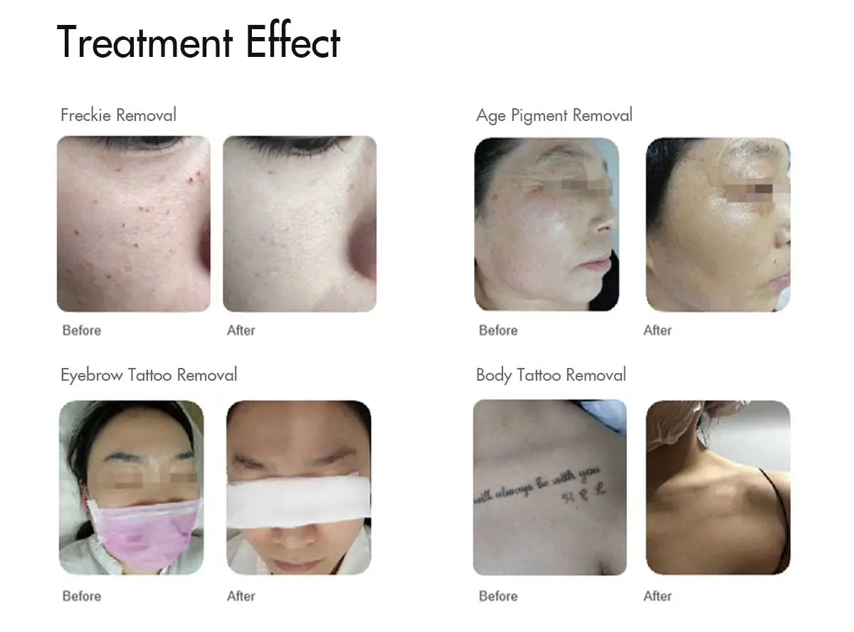 laser-tattoo-removal-machine-for-sale-of-suppliersyhh