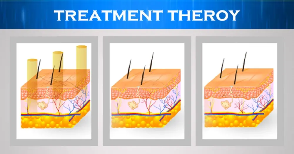 Laser Vein Removal Work Principle