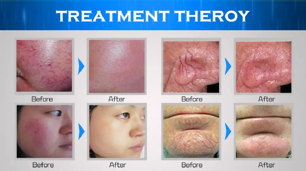 Treatment Theory