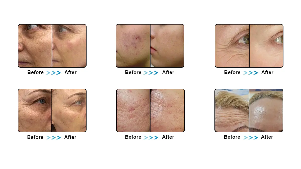 Treatment Effect Results