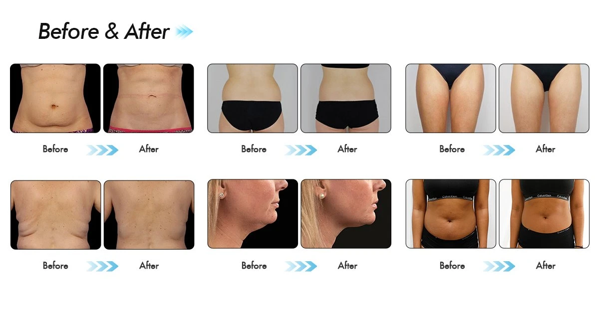 Cryolipolysis Before and After Results