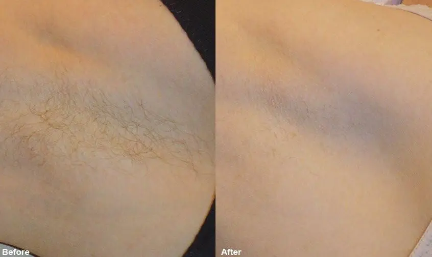 Treatment Demo 2