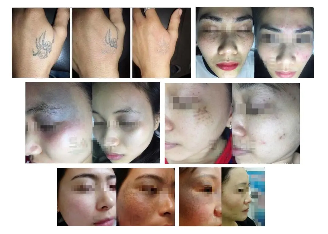 Pico laser treatment performance