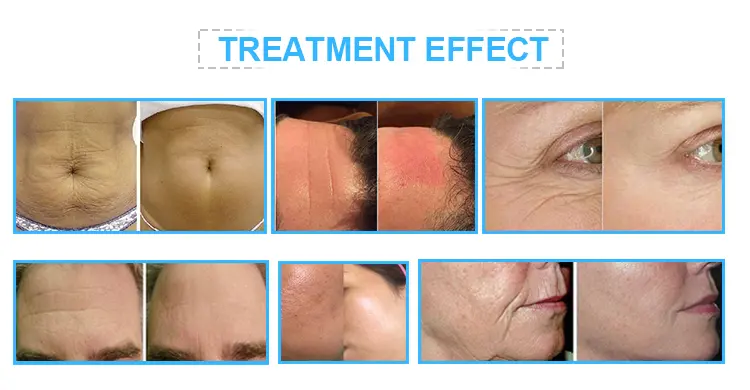Treatment process