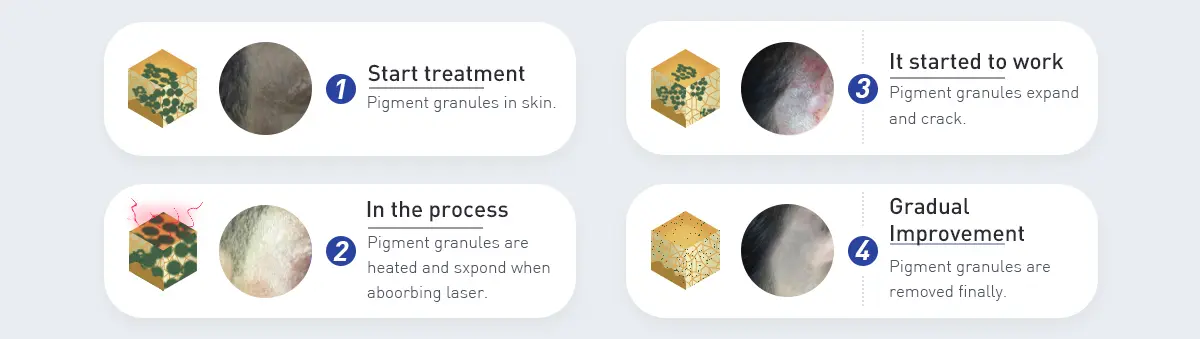 Picosecond Laser Tattoo Removal Principle