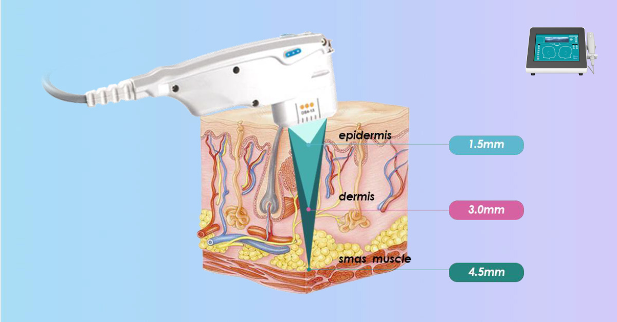 Principle of HIFU Beauty Machine