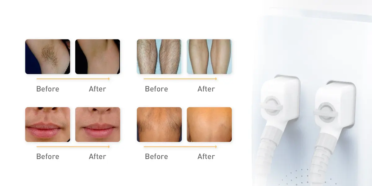 Hair Removal Treatment Effect Before and After