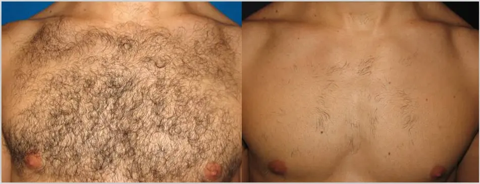 Before and after treatment 1