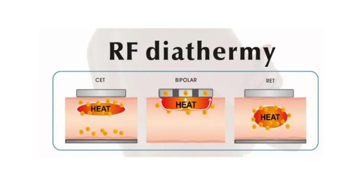 INDIBA RET High Frequency Machine Principle