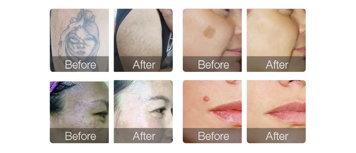 picosure tattoo removal machine for sale