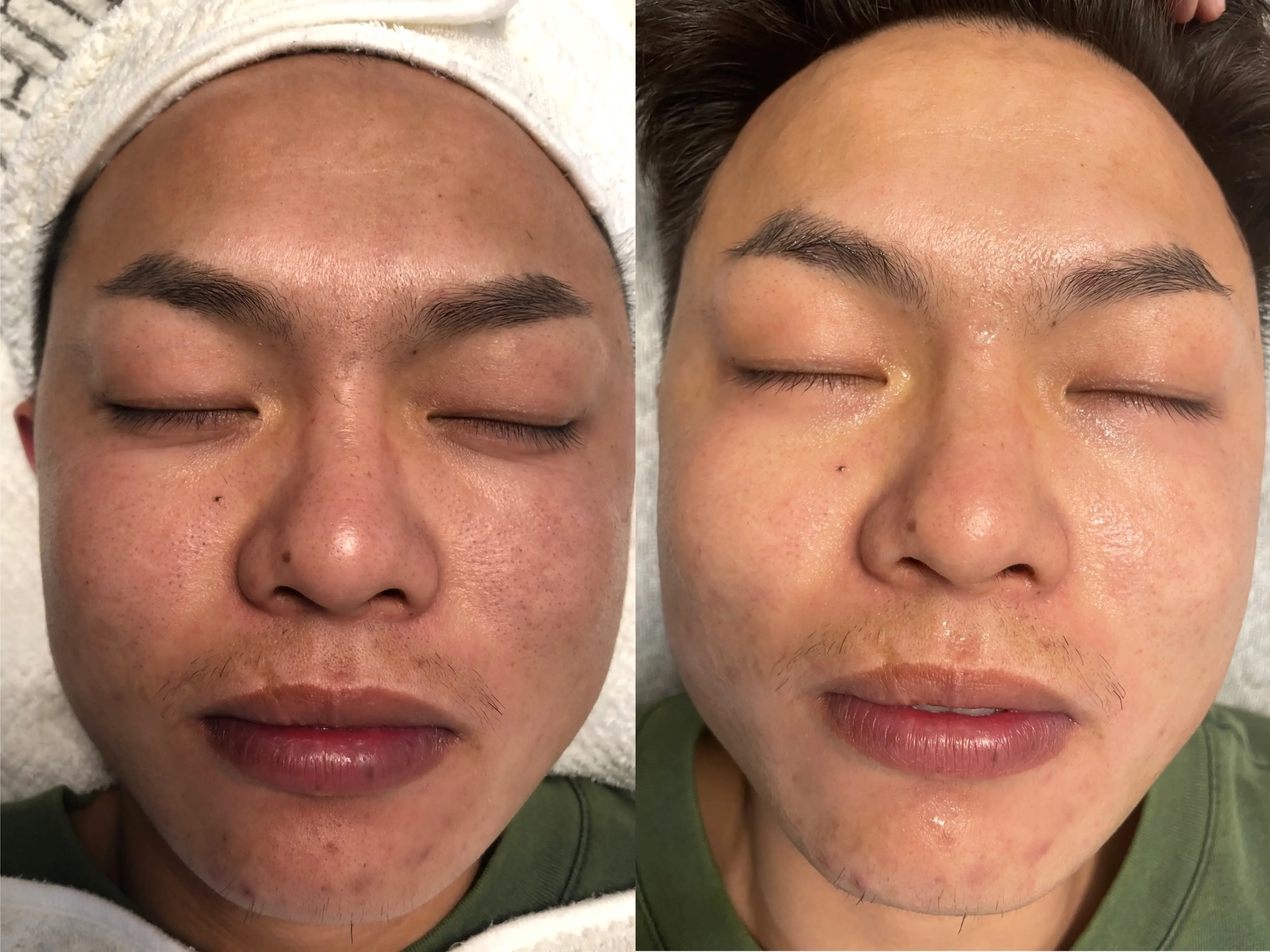 Before and After 2