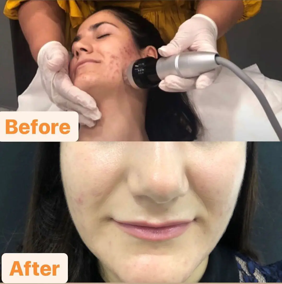 Treatment Result 2
