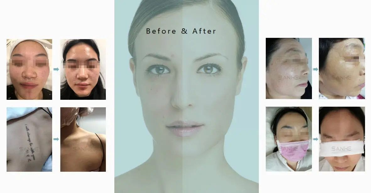 Pigmentation Treatment Principle