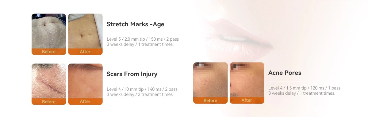 Treatment Effect Before and After