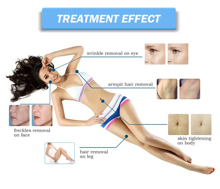 OPT IPL Technology Diagram
