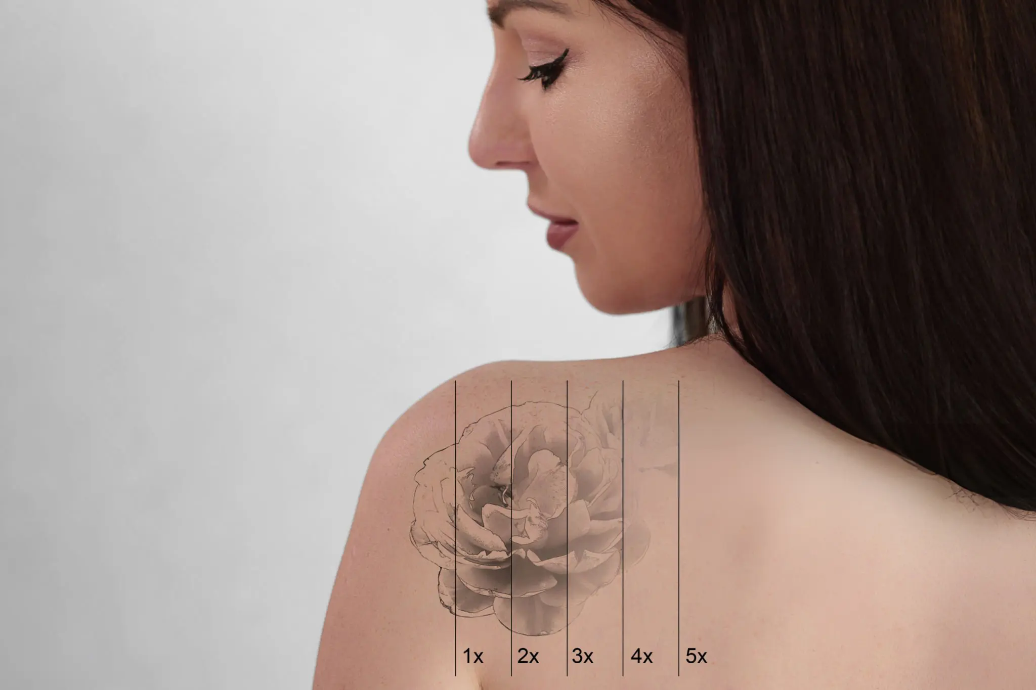 Picosecond laser pigmentation clearance result
