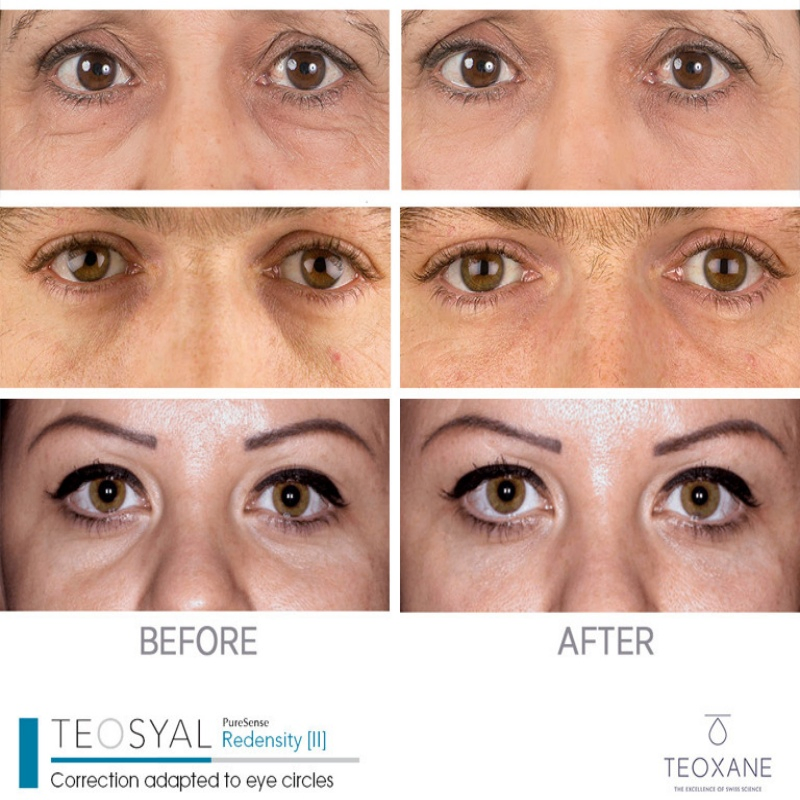 Facialgain Teosyal Redensity Under Eye Circle Tighter Whitening Cross Linked Hyaluronicaciddermalfiller Injection