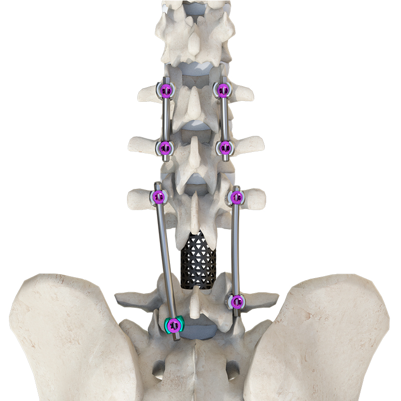Advanced Hybrid Material Fixation Connector System for Enhanced Durability