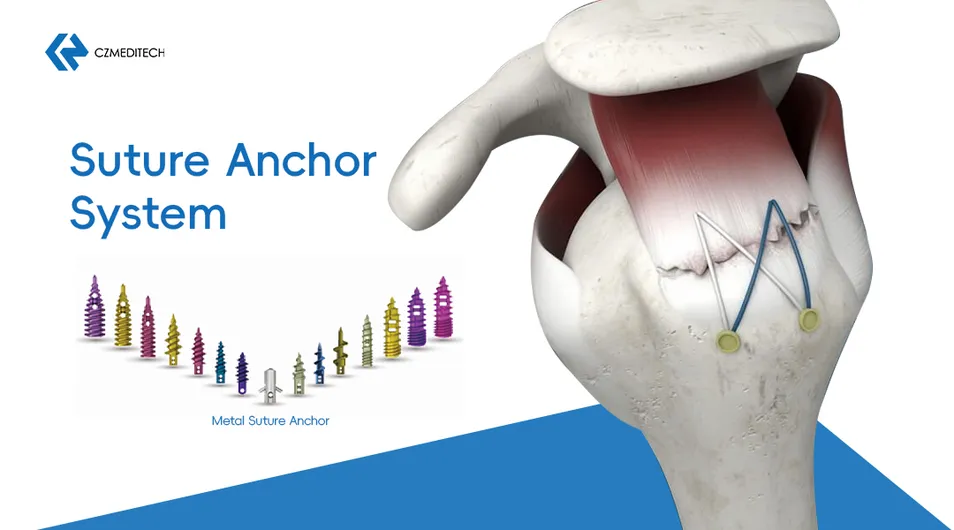 Medical Fixation Device