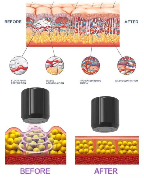Shockwave ED Treatment