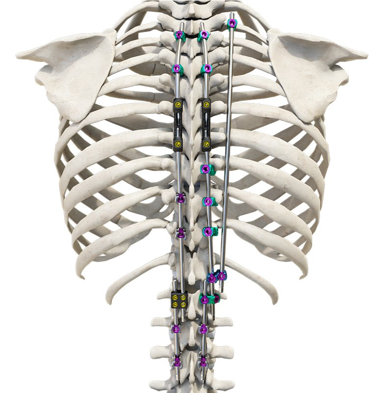 Fixation System Component 2