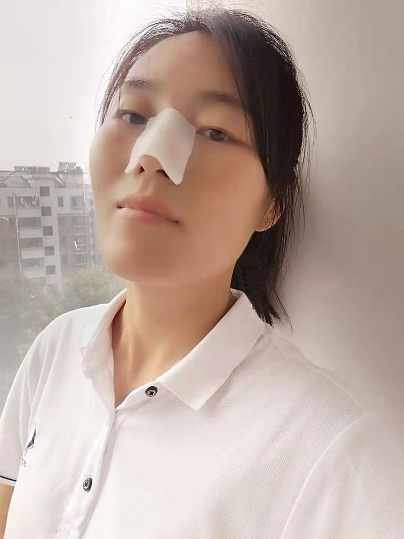 Perforated Thermoplastic Board in Post-Rhinoplasty Surgery Nose Splint Material