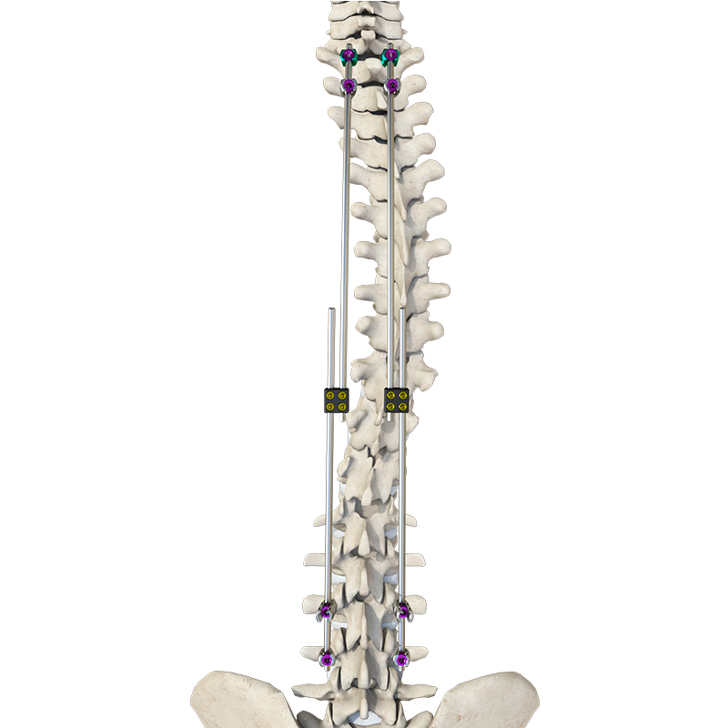 Advanced Hybrid Material Fixation Connector System for Enhanced Durability