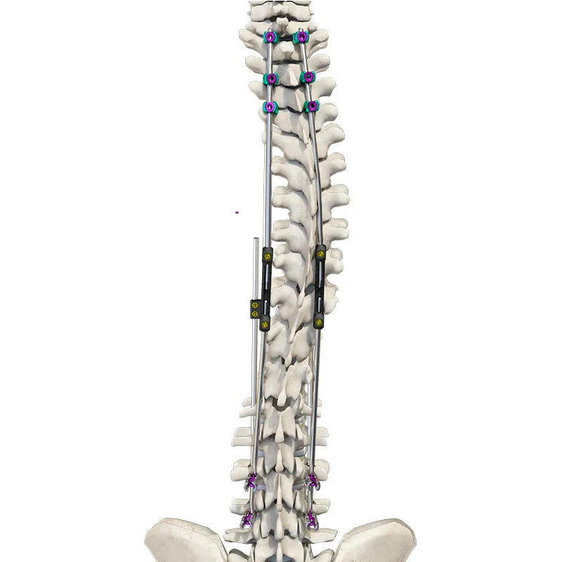 Spinal Fixation Detail 2